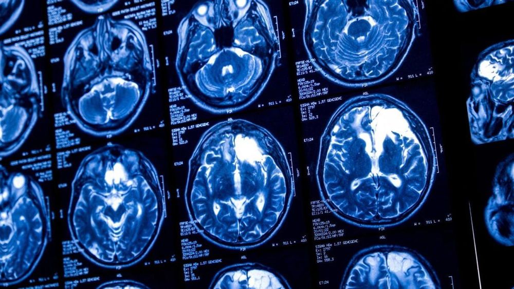 Sam Altman is reportedly launching a rival brain-chip startup to compete with Musk's Neuralink